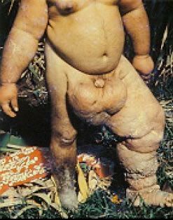elephantiasis.jpg