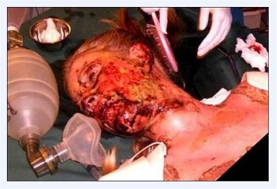 14337-poor-girls-toxic-reaction-over-counter-pain-killerbig0.jpg