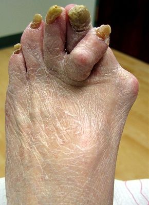 bunion.jpg