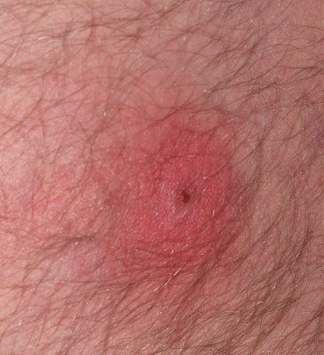 mrsa.jpg