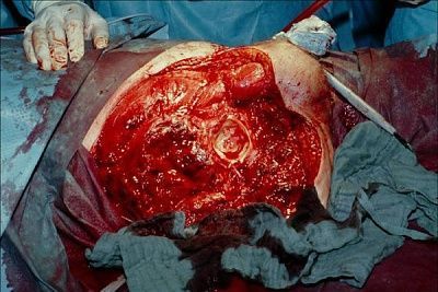 hemipelvectomy_gas_gangrene.jpg