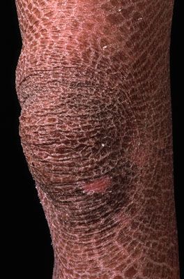 ichthyosis2.jpg