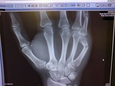 brokenhandxray1.jpg