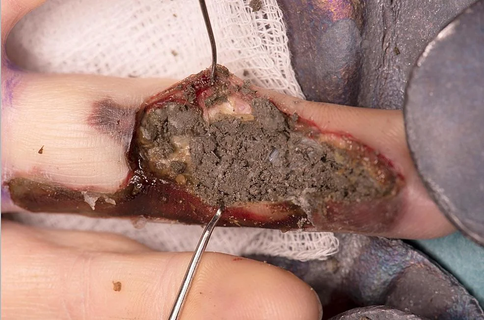 finger-accidentally-injected-with-liquid-concrete-v0-sex730il6gtb1.webp