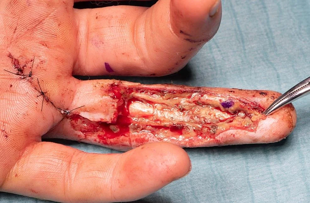 finger-accidentally-injected-with-liquid-concrete-v0-1b6mm7il6gtb1.webp