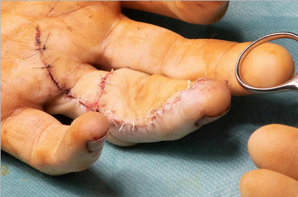 finger-accidentally-injected-with-liquid-concrete-v0-93sw18il6gtb1.webp