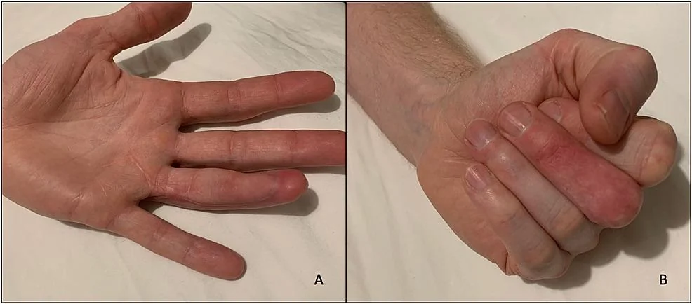 finger-accidentally-injected-with-liquid-concrete-v0-2fy538il6gtb1.webp