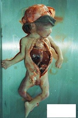 fetus-3.jpg