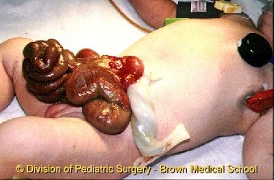 gastroschisis1.jpg