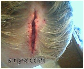 3_03_05%20Laceration%201%20day%20after%20surgery.jpg