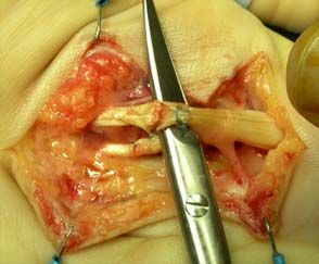 Tendon_both_repaired_DSCN1768.jpg