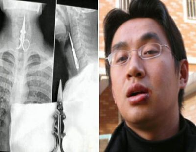 abc_scissors_swallowed_090402_ssh.jpg