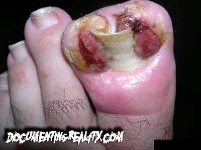 an ingrown toenail.jpg
