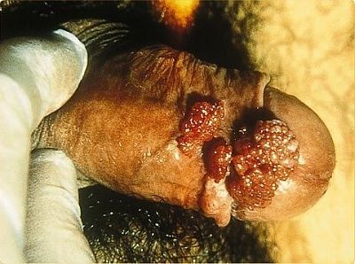 condylomata-acuminata-man.jpg