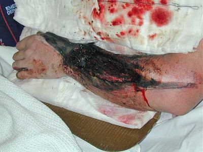 degloving-injury-left-arm.jpg