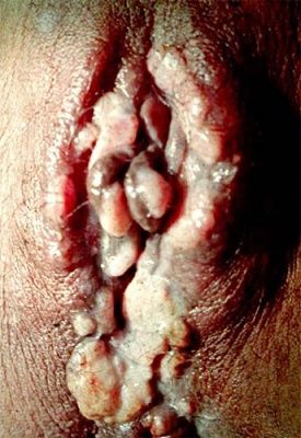 female-syphilis-infection.jpg