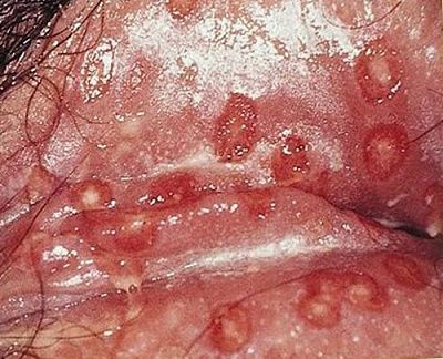 pussy-herpes.jpg