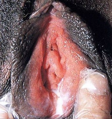 female-gonorrhea.jpg