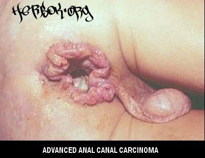 analcancer.jpg