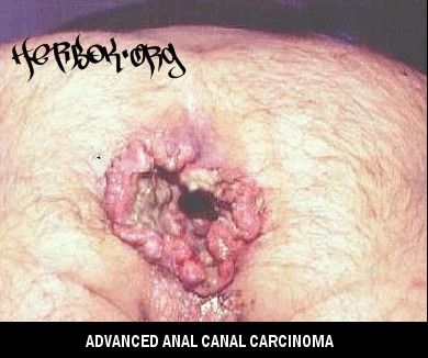 analcancer2.jpg