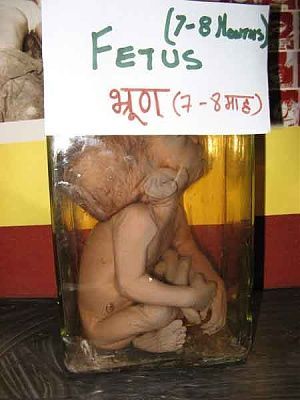 fetus-head-abnormality.jpg
