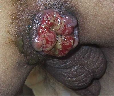 gay-bowel-syndrome-.jpg