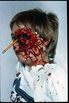 eye-injury-7.jpg