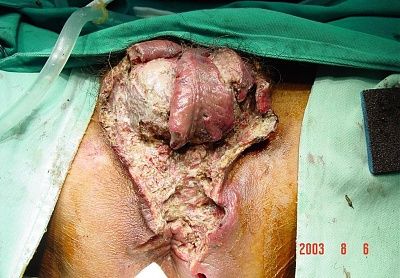 granuloma-inguinale-.jpg
