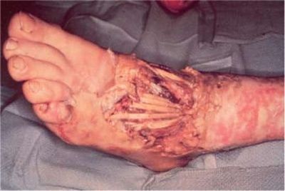acid-burn-521d2146-5.jpg