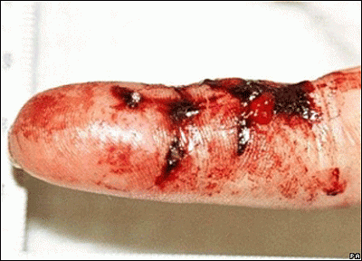 _44146317_injuries1pa203b.gif
