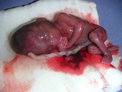 aborto.JPG