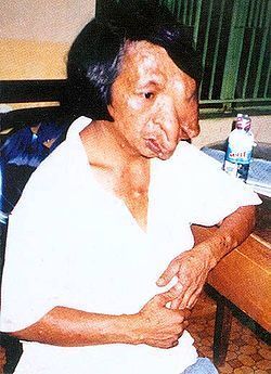 250px-Agent-orange-deformities-vietnam.jpg