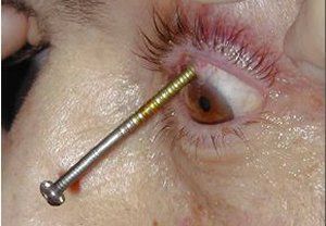 eye_nail.jpg
