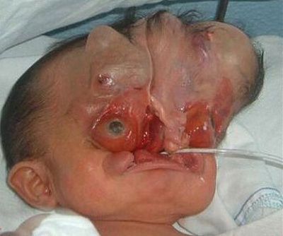 cloverleaf-skull-baby_1.jpg