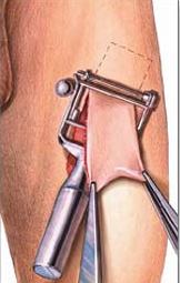 skin graft.jpg