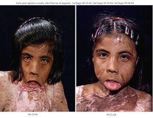 skin graft sweden.jpg