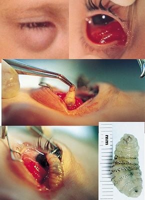 eyeworm.jpg