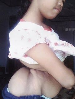 Maya-752741extreme spinal curvature.jpg
