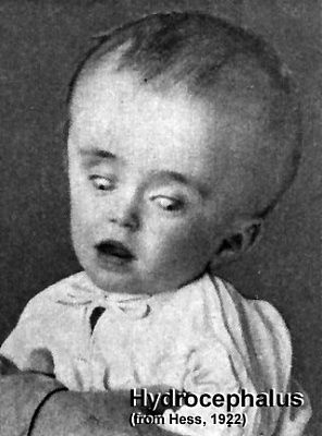 hydrocephalus.jpg