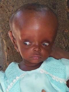 hydrocephalus240x320.jpg