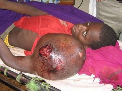 sarcoma-left-shoulder.jpg