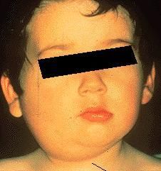 mumps.jpg