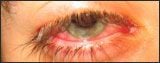 eye-infections.jpg