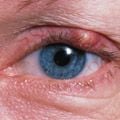 stye.jpg