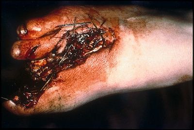 amputation-foot_-leg-2.jpg