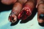 Arm_hand-amputation-26-150x99.jpg