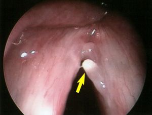 polyp.jpg