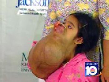 tumor__oPt.jpg