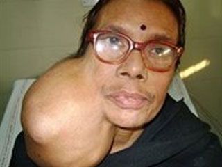 0_61_facial_tumor_320.jpg