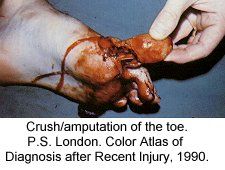 festered_limbs_feet_fingers052.jpg